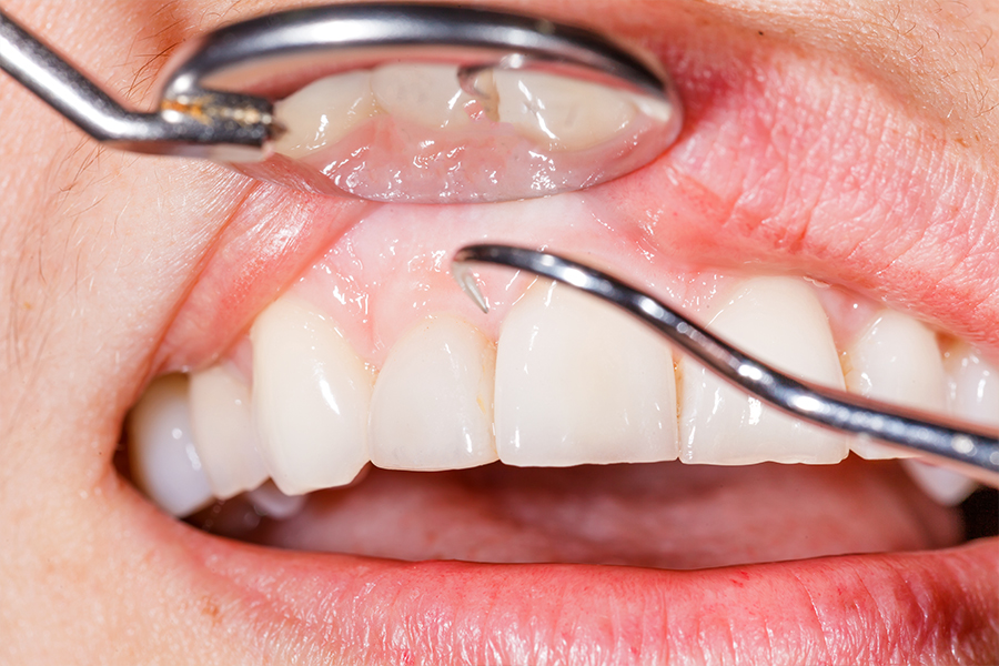 歯周病とはどんな病気か