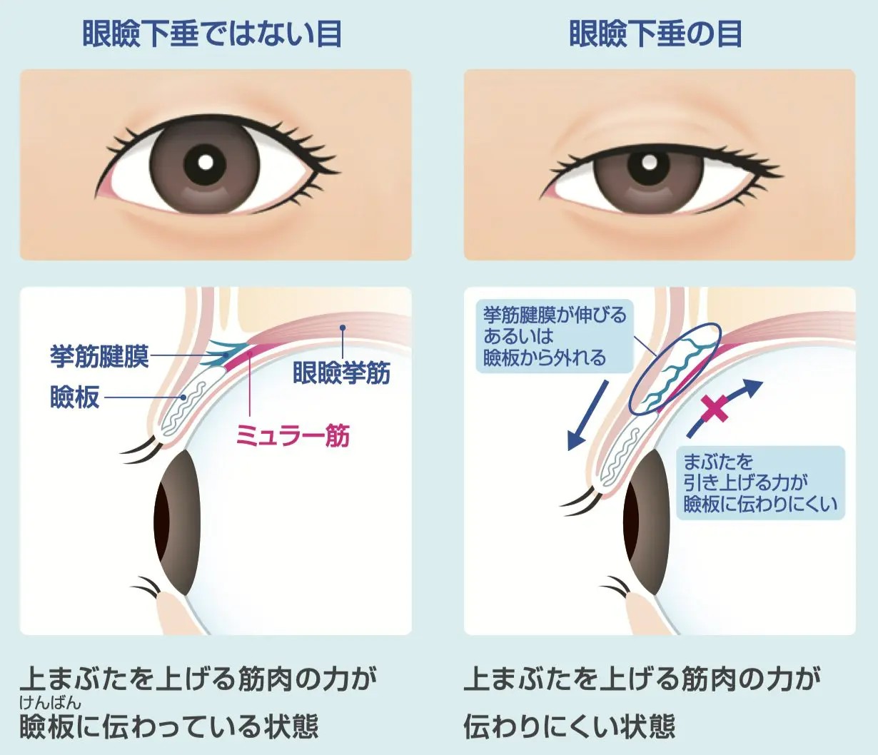 眼瞼下垂のメカニズム